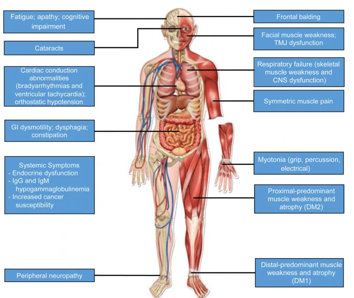 Myotonic Dystrophy (DM)